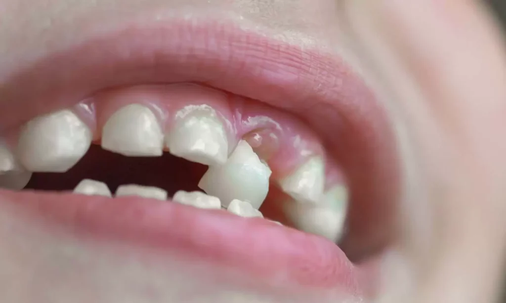 Broken Tooth Emergency Dentistry At Carina, Brisbane, Carina Gardens Dental