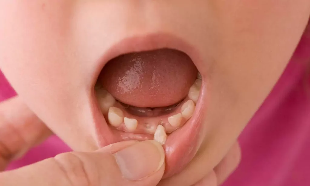 Knocked Out Tooth Emergency Dentistry At Carina, Brisbane, Carina Gardens Dental