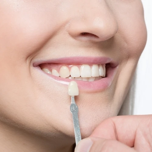 Porcelain Veneers Near Carina Gardens Dental, Carina, Brisbane