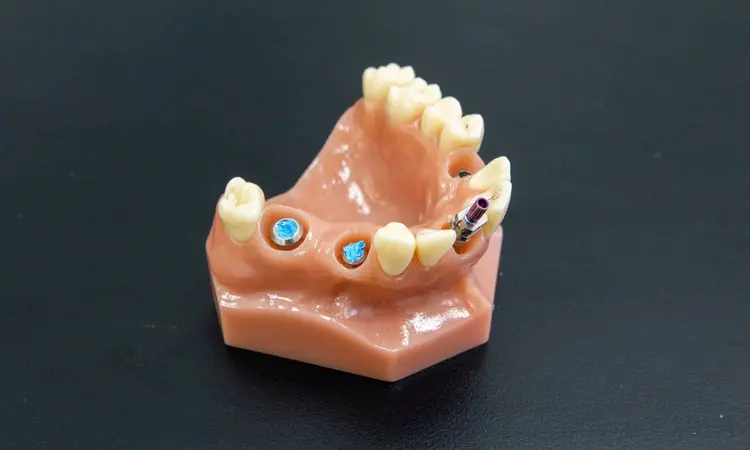 Restorative Dentistry at Carina Gardens Dental