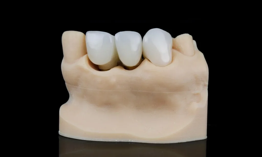 Cantilever Bridge At Carina, Brisbane, Carina Gardens Dental