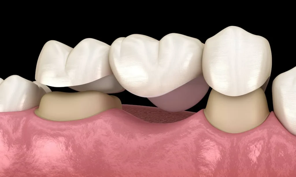 Traditional Bridge In Carina, Brisbane, Carina Gardens Dental