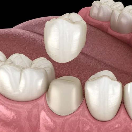 Dental Crowns At Carina, Brisbane, Carina Gardens Dental
