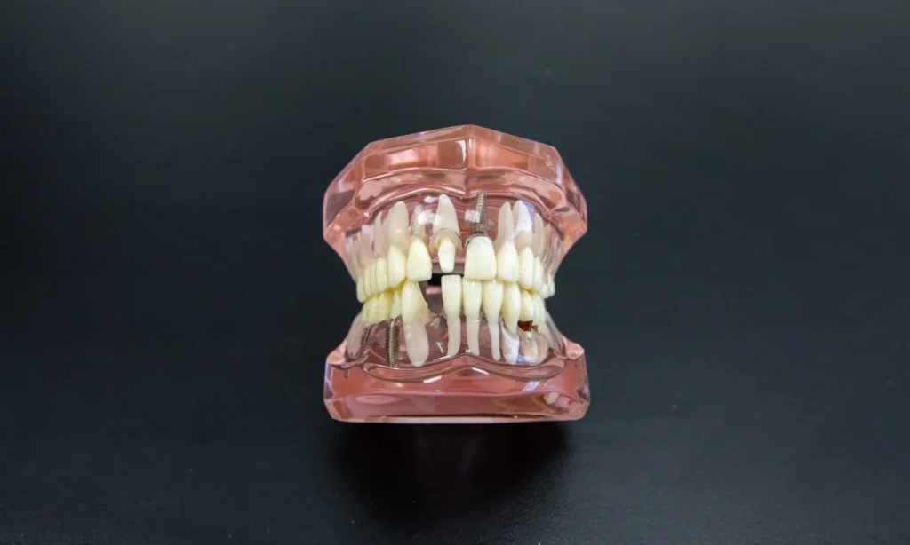 What Is A Dental Implant At Carina, Brisbane, Carina Gardens Dental