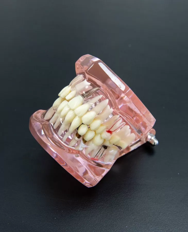 Dental Implants For Dentures And Bridges At Carina, Brisbane, Carina Gardens Dental