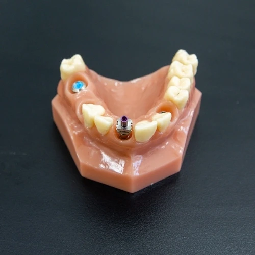 Dental Implants In Carina Gardens Dental, Carina, Brisbane