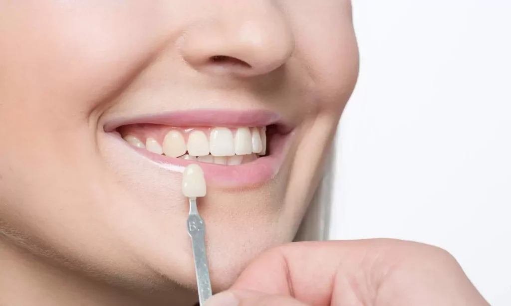 Porcelain Dental Veneers In Carina, Brisbane, Carina Gardens Dental