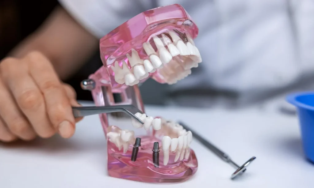 Implant Supported Bridge At Carina, Brisbane, Carina Gardens Dental