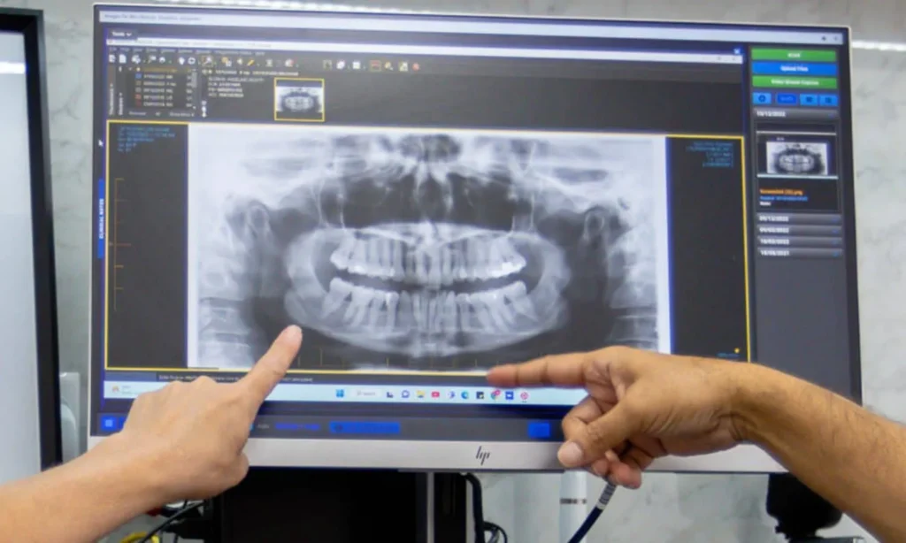 Root Canal Therapy At Carina, Brisbane, Carina Gardens Dental