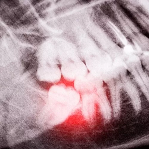 The Problem With Wisdom Teeth At Carina, Brisbane, Carina Gardens Dental