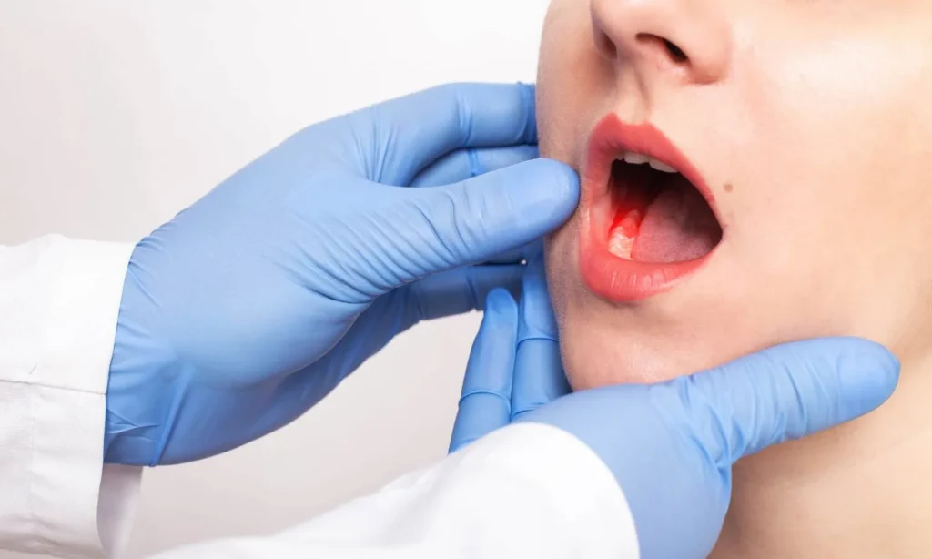 The Stages Of Gum Disease At Carina, Brisbane, Carina Gardens Dental