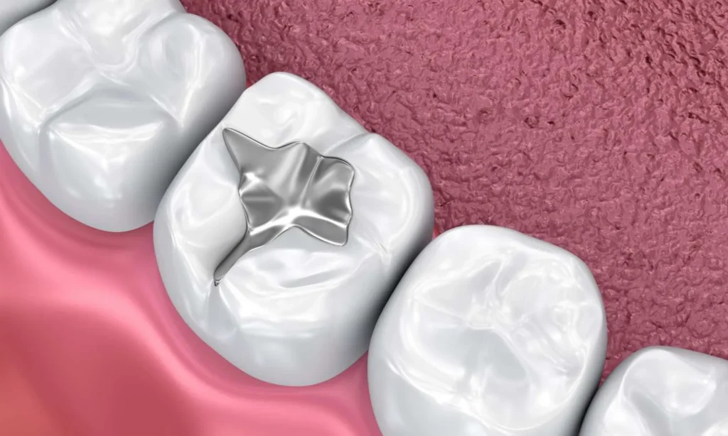 Dental Fillings At Carina, Brisbane, Carina Gardens Dental