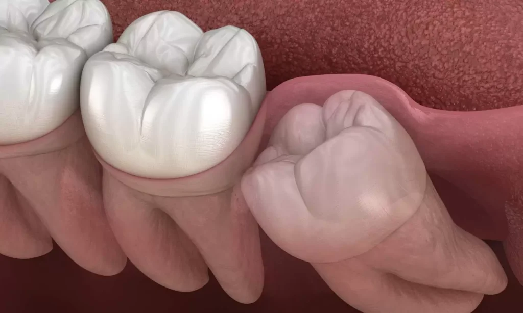 What Is A Wisdom Teeth At Carina, Brisbane, Carina Gardens Dental